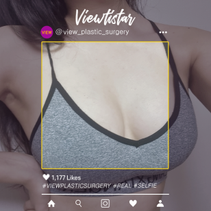 [Breast Augmentation] Lee Yeonju