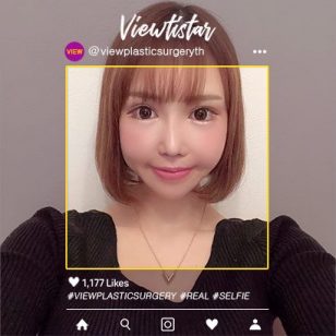 [Zygoma Reduction, Lateral Canthoplasty revision, Lateral Hotz Canthoplasty revision]