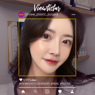 [Rhinoplasty revision, Pyriform Augmentation] Jiwoo