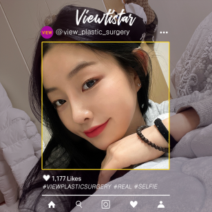 [Rhinoplasty, Fat graft surgery] Kim Jungah