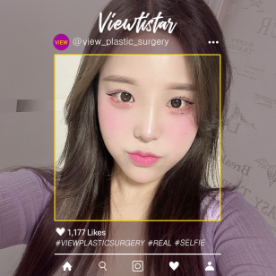 [Rhinoplasty, Epicanthoplasty, Lateral Canthoplasty, Lateral Hotz Canthoplasty] Lee Jieun