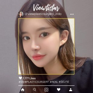 [Kontur Wajah 3 Jenis + Revisi buka sudut depan mata + Operasi Hidung + Filler (Wajah, Filtrum)] Lee Hyejin | Plastic Surgery Korea
