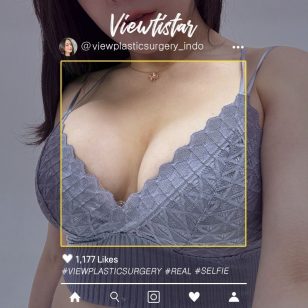 [Operasi Payudara (Motiva)] Maeng Jihye | Plastic Surgery Korea