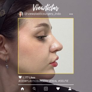 [Operasi Hidung] Maria | Plastic Surgery in Korea