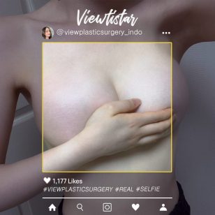 [Operasi Payudara (Motiva)] Kim Chaea | Plastic Surgery in Korea