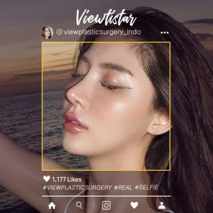 [Operasi revisi hidung+Operasi Mata+pengecilan] Sasi Ngiunwan | Plastic Surgery Korea