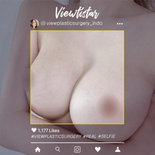 [Revisi pengencangan payudara (Mentor Extra)] Seo Hayong | Plastic Surgery Korea