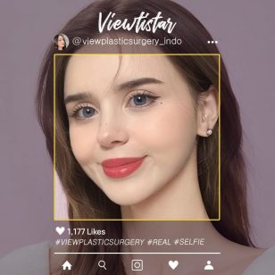 [Tarik Benang + Isi lemak (Dahi, Pelipis, Garis senyum, Dagu, Pipi)] Sude Uygun | Plastic Surgery Korea