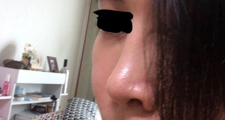 Rhinoplasty 성형 후기 올려요~~!!