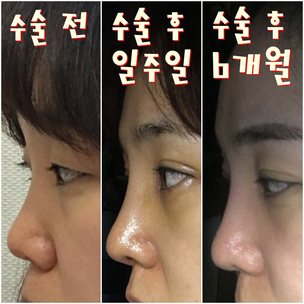 눈,Rhinoplasty 수술 후 6개월 후기입니다