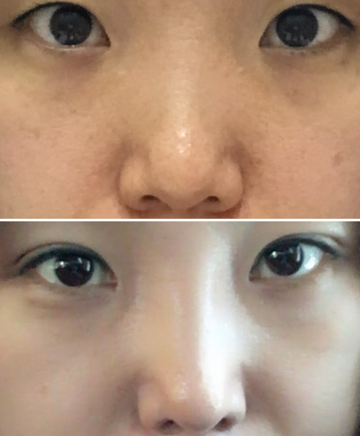 눈, Rhinoplasty 수술후기 입니다