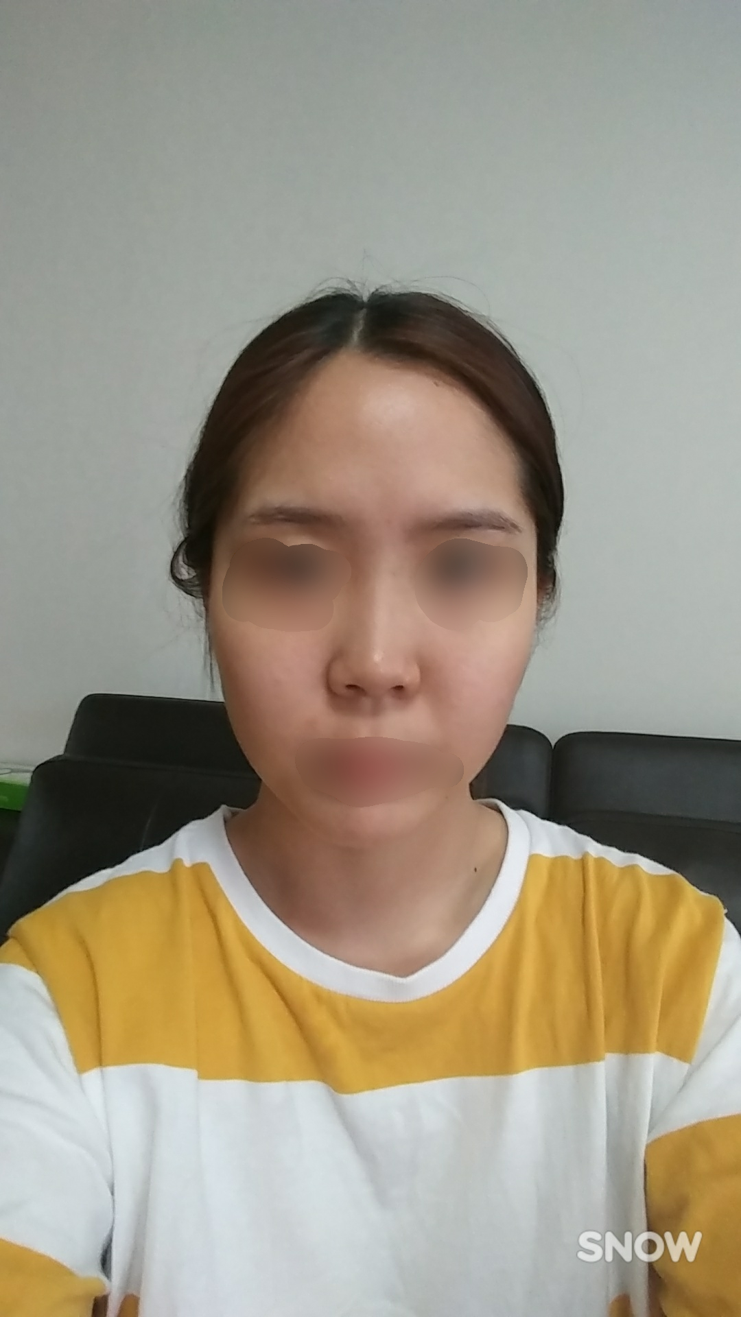 Rhinoplasty성형 3개월차 후기에요~~