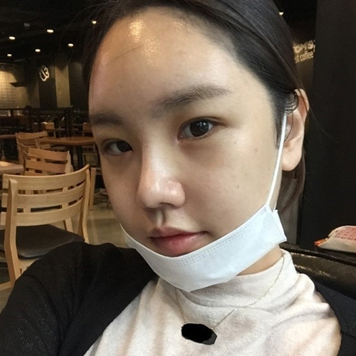 안면윤곽 8일차~2주차 후기쓰러 왔어요!(안면윤곽,Rhinoplasty,눈,지방이식)