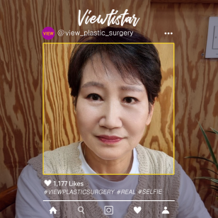 [Brow Lift + Lower blepharoplasty + Thread lift] Lim Jeong