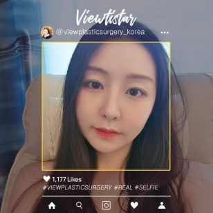 [Facial Contouring + Rhinoplasty + Double Eyelid Surgery] Lee Yujin | Plastic Surgery Korea