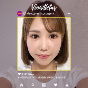Double Jaw + 3 Types Face Countouring + Lateral Canthoplasty