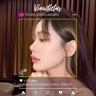 [Revisional Rhinoplasty] Malin Sae-Lim