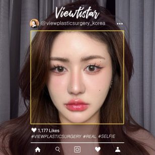 [Повторная блефаропластика+Повторная ринопластика] Ploywarat Nithidechathorn | Plastic surgery Korea