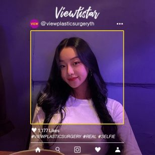 [เสริมจมูก + ฉีดไขมันหน้า] Kim Jeonga