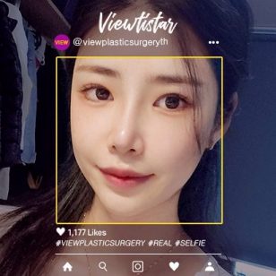 [Yun Migyeong] โครงหน้า 3 จุด + แก้ไขจมูก + แก้ชั้นตาสองชั้น ฉีดไขมันหน้า (Full face)