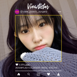 [เสริมจมูก + ทำตาสองชั้น+ปรับกล้ามเนื้อตา + เปิดหัวตา] Lee suyeon