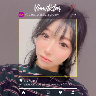 [แก้ชั้นตาสองชั้น+ปรับกล้ามเนื้อตา + แก้ไขจมูก] Kim Minji