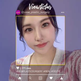 [แก้ชั้นตาสองชั้น+ปรับกล้ามเนื้อตา + เสริมจมูก] Jeong Miseon | Plastic Surgery Korea