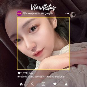[โครงหน้า 3 จุด+ศัลยกรรมจมูก(งานแก้)+ฉีดไขมันหน้า] Kim Minji | Plastic Surgery Korea