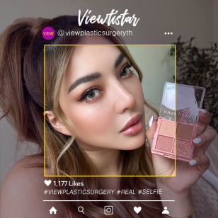 [แก้จมูก(กระดูกอ่อนซี่โครงบริจาค)] Noppaluck Kunthawatchai | Plastic Surgery Korea