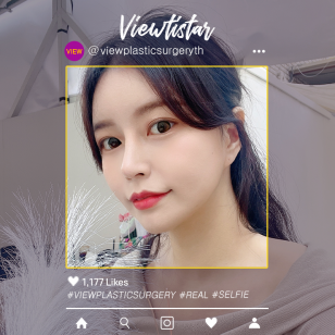 [โครงหน้า 3 จุด (ลดขนาดโหนกแก้ม+ตัดกราม+ตกแต่งคาง) + เสริมจมูก] Kim Hyunjin | Plastic Surgery Korea