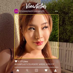 [ศัลยกรรมแก้จมูก (ใช้กระดูกซี่โครงของตัวเอง)]  Jattuporn Tassananutriyakul | Plastic Surgery Korea