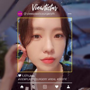 [ฉีดไขมันหน้า + ร้อยไหม + ทำตาสองชั้น + ฉีดรีจูรัน] An Sejin | Plastic Surgery Korea