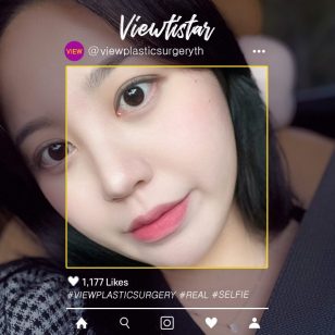 [แก้ชั้นตาสองชั้น + ปรับกล้ามเนื้อตา] Jo Heejoo | Plastic Surgery Korea