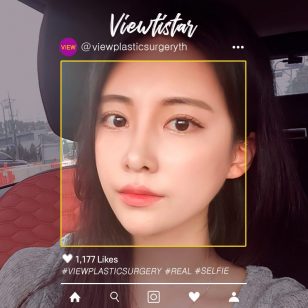 [ทำตาสองชั้น+เสริมจมูก+ฉีดไขมันหน้า+ดูดไขมันเหนียง] Kim Jieun | Plastic Surgery Korea
