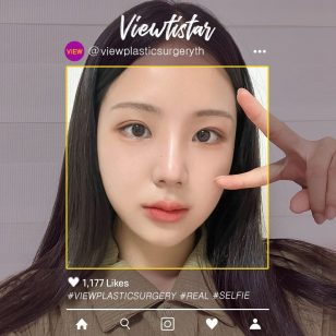 [โครงหน้า 3 จุด+เสริมจมูก+ทำตาสองชั้น] Kim Jaeeun | Plastic Surgery Korea