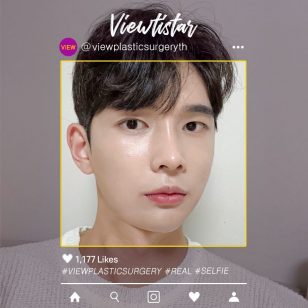 [โครงหน้า 3 จุด+ฉีดไขมันหน้า+ศัลยกรรมจมูก] Choi Hyougwoo | Plastic Surgery Korea