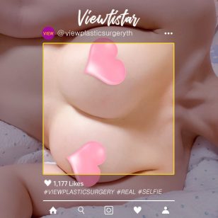 [ศัลยกรรมเสริมหน้าอก] Oh Yumi | Plastic Surgery Korea