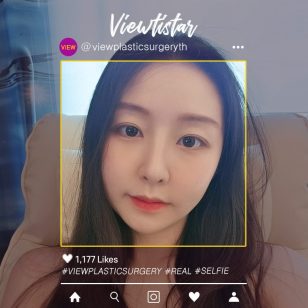 [โครงหน้า 3 จุด+ทำตาสองชั้น+เสริมจมูก] Lee Yujin | Plastic Surgery Korea