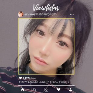 [ทำตาสองชั้น + แก้จมูก + ฉีดไขมันหน้า + ร้อยไหม] Kim Minji | Plastic Surgery Korea