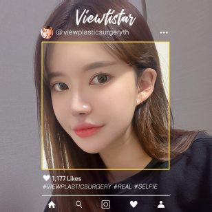 [โครงหน้า 3 จุด + เปิดหัวตา งานแก้ + เสริมจมูก +ฉีดฟิลเลอร์ (หน้า+ปาก)] Lee Hyejin | Plastic Surgery Korea