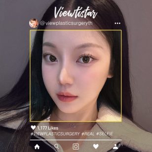 [โครงหน้า 3 จุด + แก้จมูก] Song Gayoung | Plastic Surgery Korea