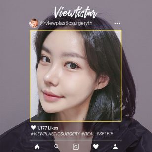 [โครงหน้า 2 จุด + เสริมร่องแก้มด้วยซิลิโคน + แก้จมูก] Lee Yuna | Plastic Surgery Korea