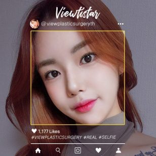 [โครงหน้า 3 จุด+ฉีดไขมันหน้า] Kim Heesun | Plastic Surgery Korea