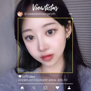 [โครงหน้า 3 จุด+ทำตาสองชั้น+เสริมจมูก] Lee Hyoeun | Plastic Surgery Korea