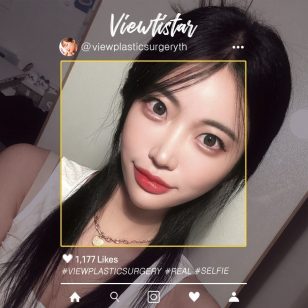 [ทำตาสองชั้น] Lee hyein | Plastic Surgery Korea