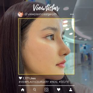 [โครงหน้า 3 จุด + เสริมจมูก] Sitthinisa Siriwangchai | Plastic Surgery Korea