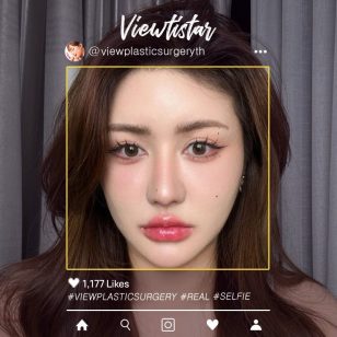 [แก้ชั้นตาสองชั้น+แก้จมูก] Ploywarat Nithidechathorn | Plastic Surgery Korea