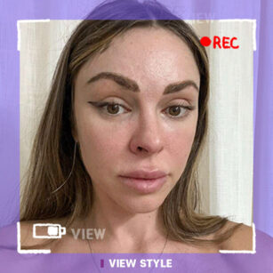 รีวิวไดอารี่ศัลยกรรมของฉันกับ Mini Facelift ในเกาหลี