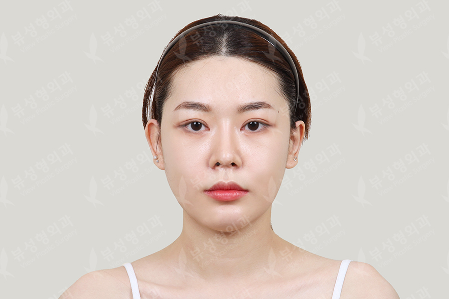 Facial Contouring surgery at ID Hospital Korea.  Facial contouring, V line  surgery, V shape face