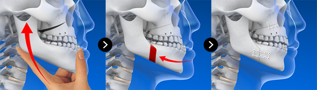 Explanation of the two-jaw surgery process